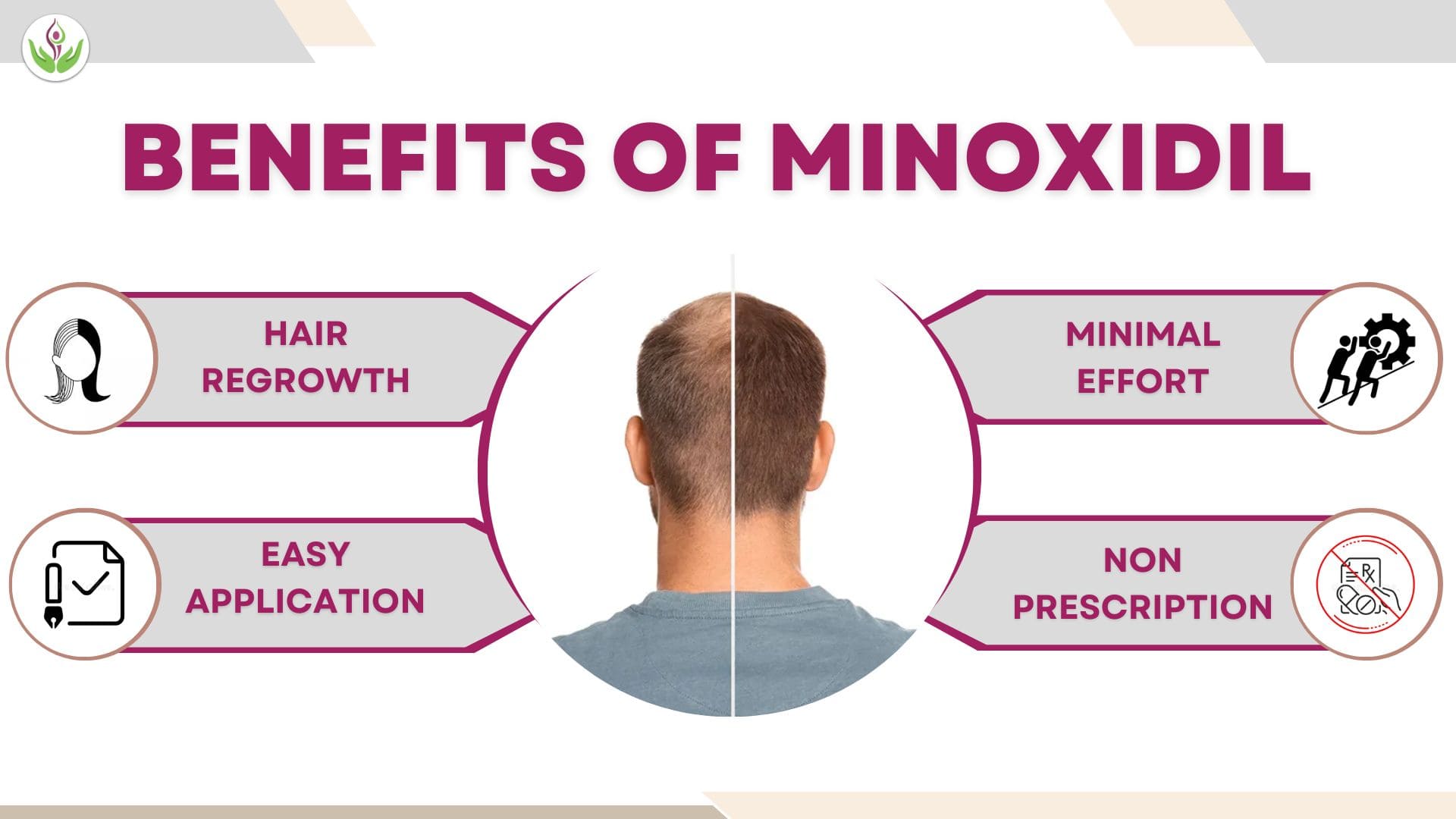 Minoxidil Side Effects For Men And Women A Comprehensive Guide Dr Sandeep Bhasin 6291