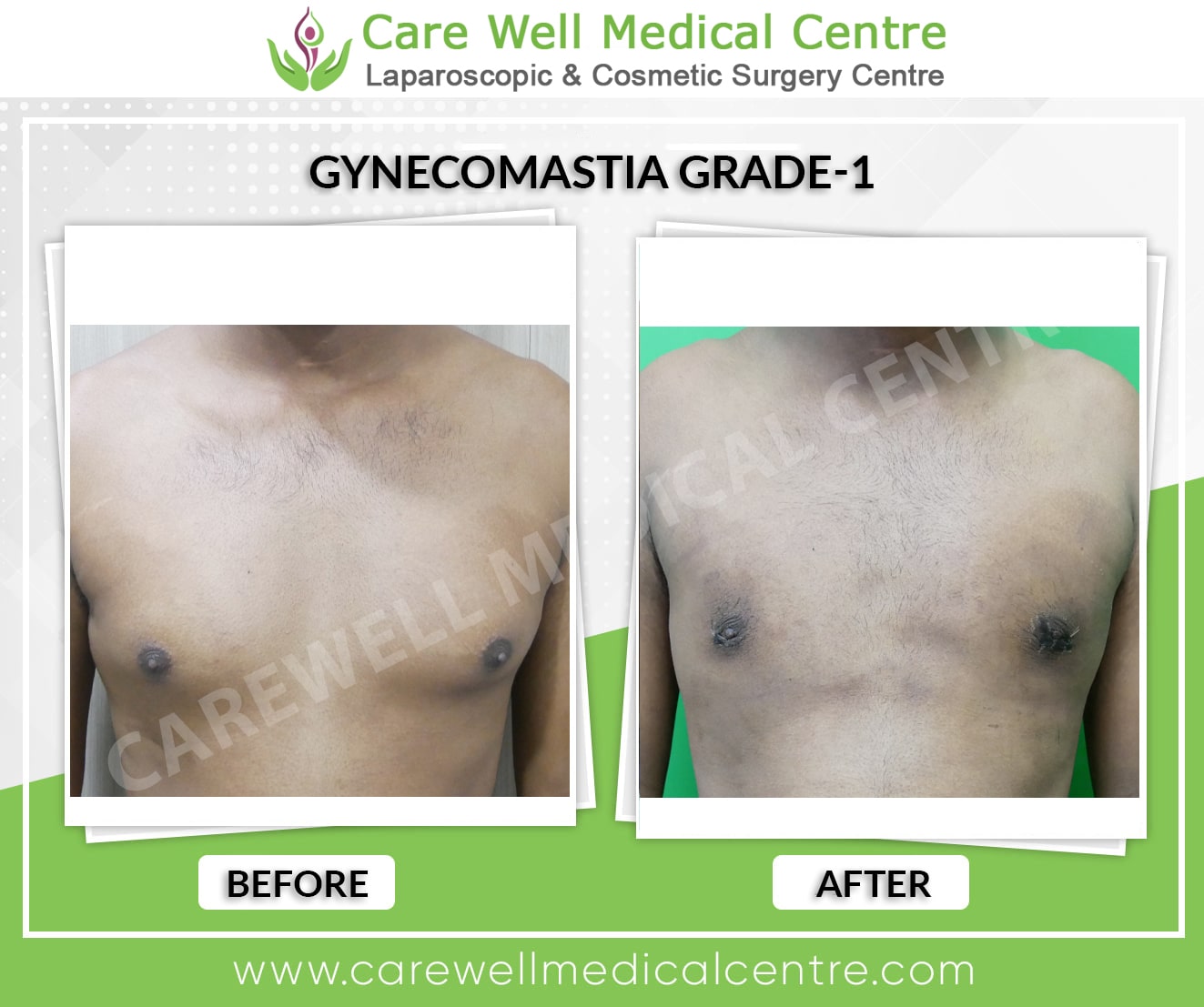 Best Gynecomastia Surgery In Delhi | Affordable Cost | Dr. Sandeep Bhasin