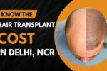 Cost of Hair Transplant in Delhi NCR 2024