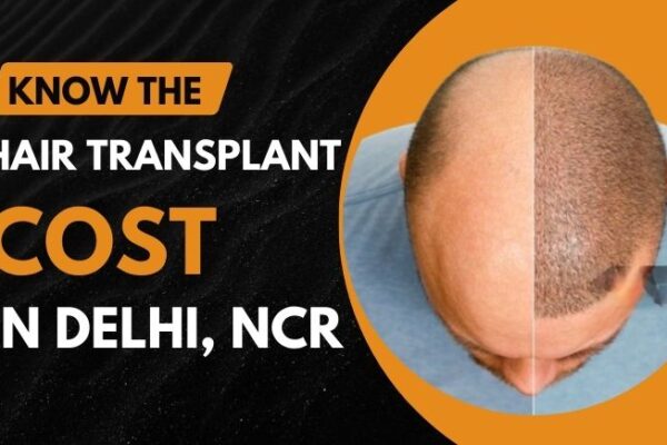 Cost of Hair Transplant in Delhi NCR 2024