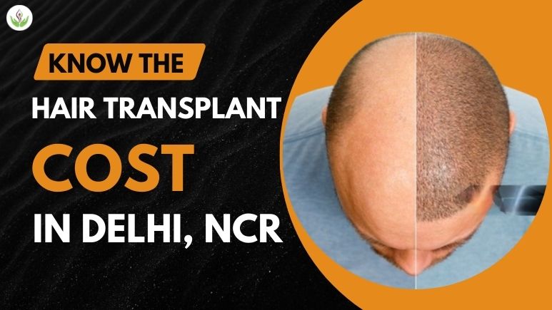 Cost of Hair Transplant in Delhi NCR 2024