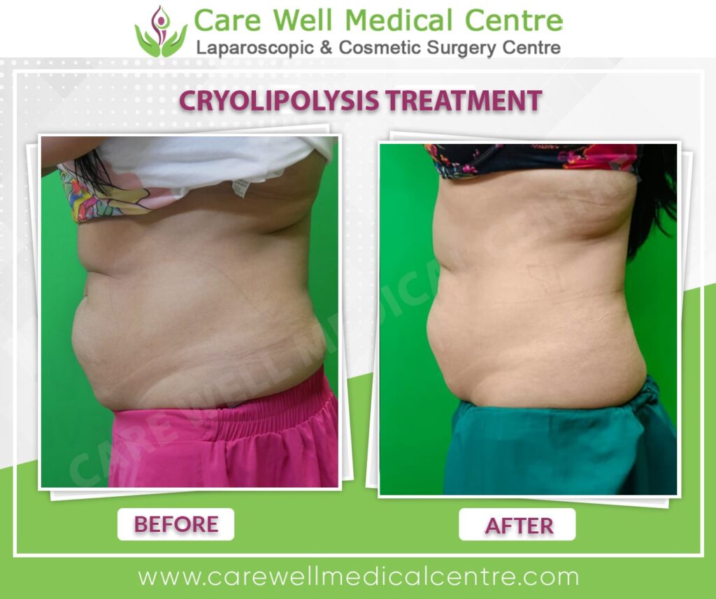 Cryolipolysis before and after result