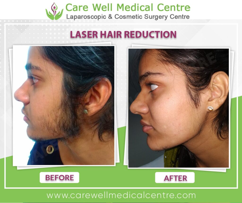 Before and after full-Facial laser hair removal results