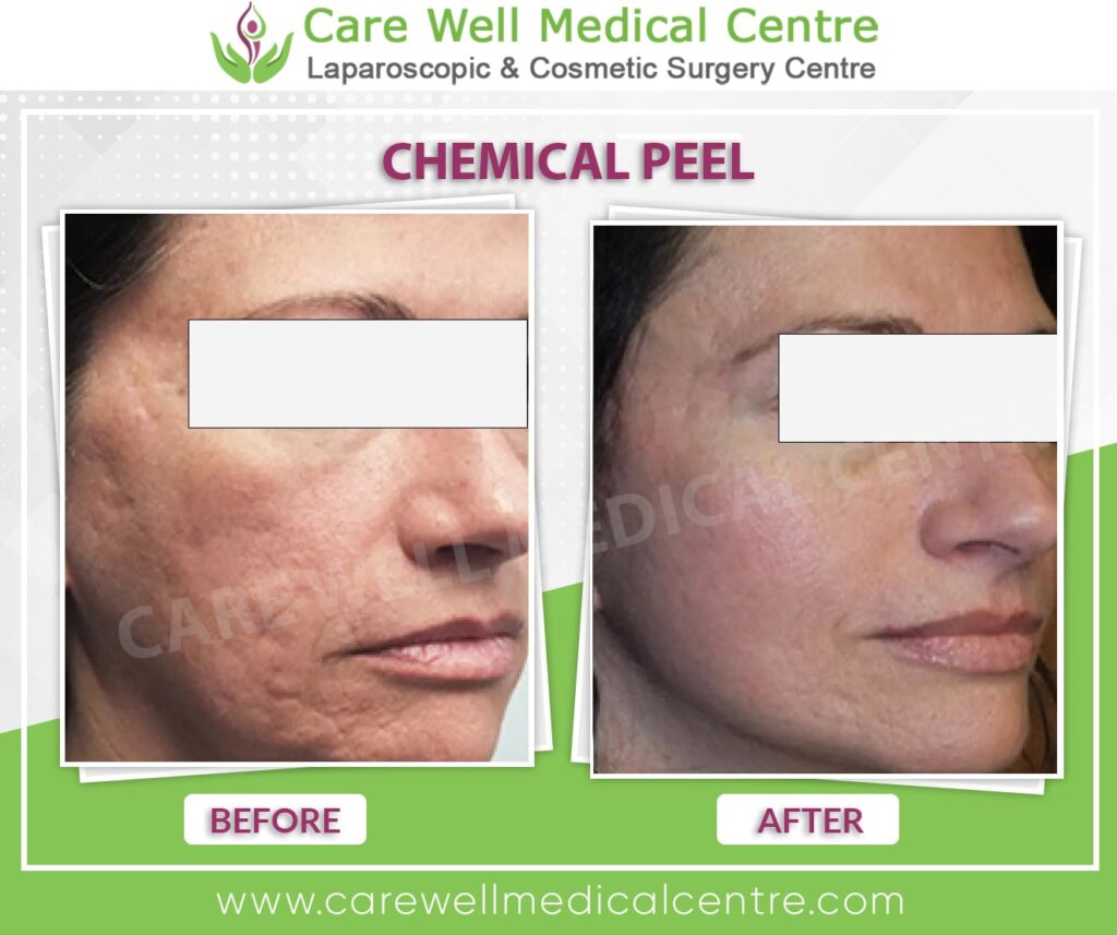 Before and After Results of Chemical Peel Treatment in Delhi