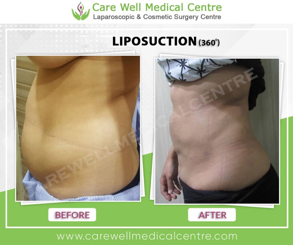 liposuction before and after result